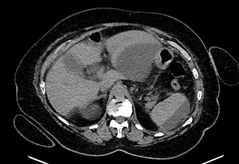 File:Biliary pancreatitis (Radiopaedia 72289-82823 Axial non-contrast 84).jpg