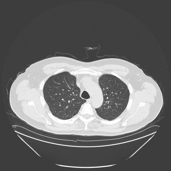 File:Birt-Hogg-Dubé syndrome (Radiopaedia 52578-58491 Axial lung window 16).jpg
