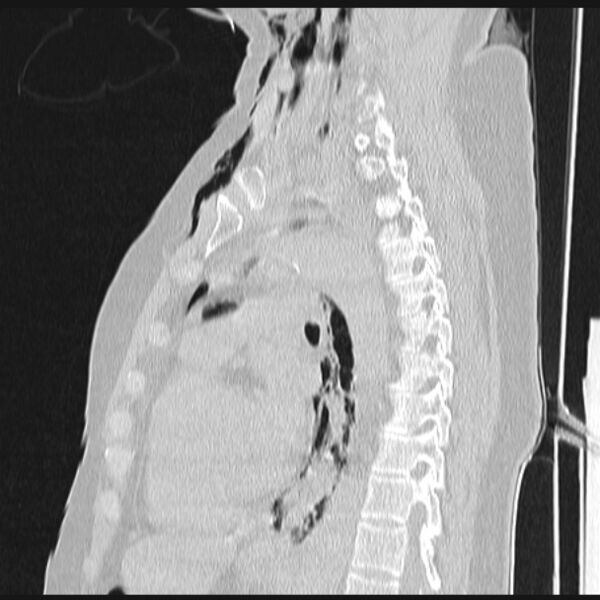 File:Boerhaave syndrome (Radiopaedia 45644-49799 Sagittal lung window 48).jpg