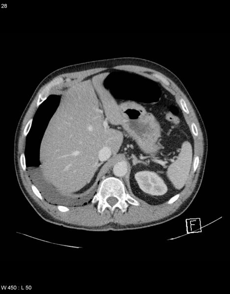 File:Boerhaave syndrome with tension pneumothorax (Radiopaedia 56794-63603 A 14).jpg