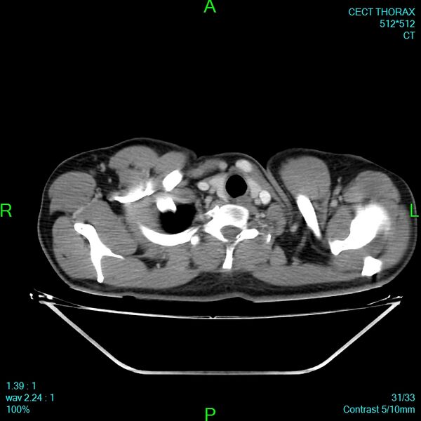 File:Bone metastases from lung carcinoma (Radiopaedia 54703-60937 Axial C+ delayed 31).jpg