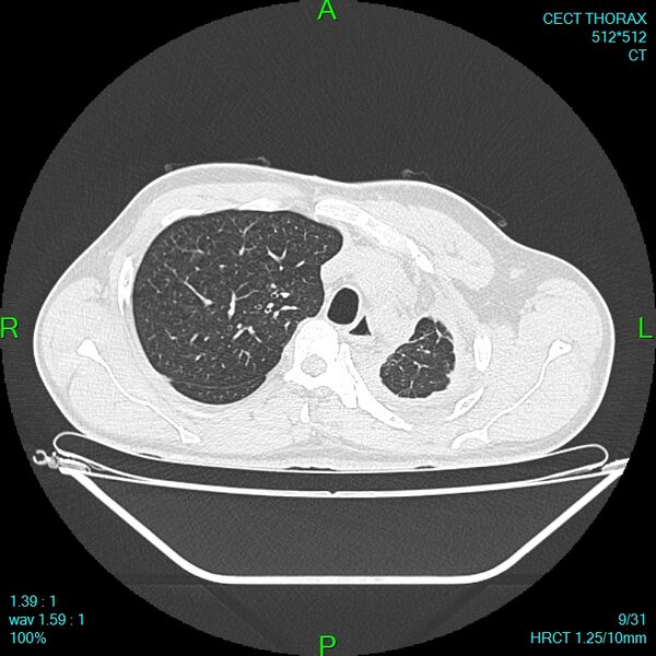 File:Bone metastases from lung carcinoma (Radiopaedia 54703-60937 Axial lung window 9).jpg