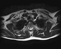 Brachial plexus birth palsy (Radiopaedia 68118-77604 Axial T2 19).jpg