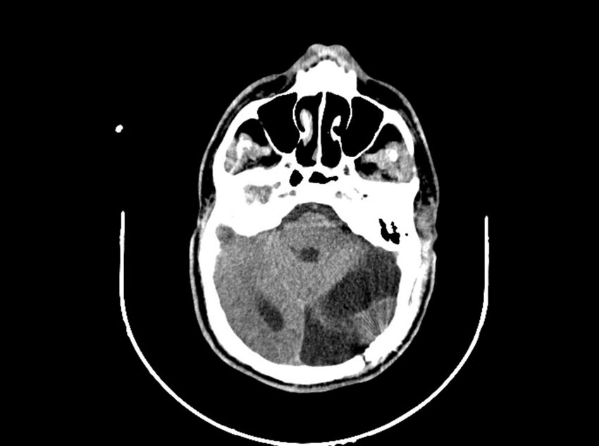 Brain injury by firearm projectile (Radiopaedia 82068-96088 A 96).jpg