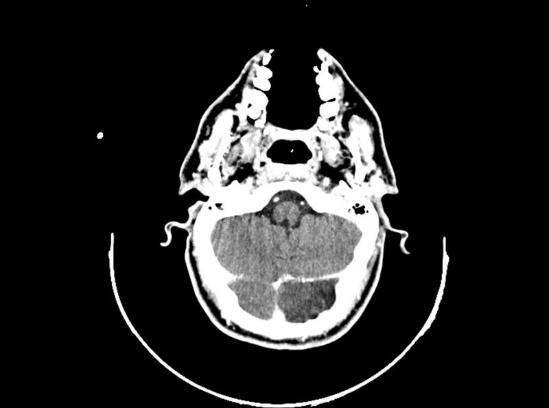 File:Brain injury by firearm projectile (Radiopaedia 82068-96088 B 73).jpg