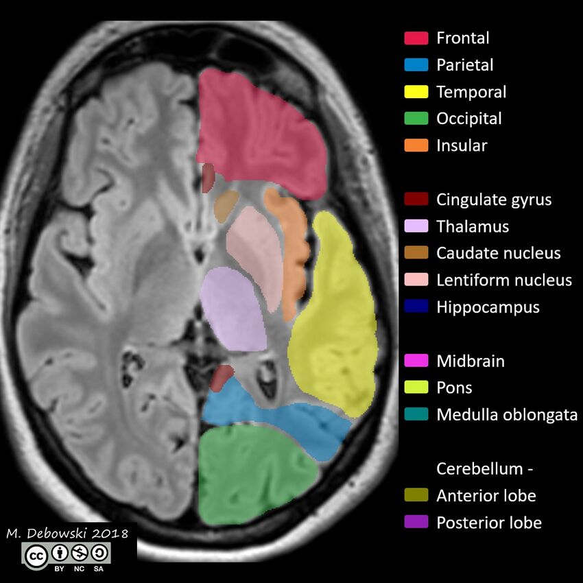 Brain lobes - annotated MRI (Radiopaedia 61691-69700 Axial 39).JPG