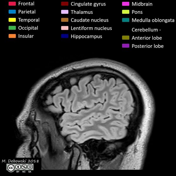 File:Brain lobes - annotated MRI (Radiopaedia 61691-69700 Sagittal 8).JPG