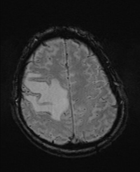 File:Brain metastases - lung cancer primary (Radiopaedia 75060-86115 Axial SWI 48).jpg