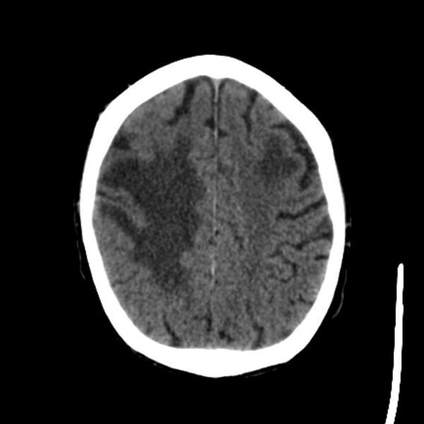 File:Brain metastases from lung cancer (Radiopaedia 27849-28092 Axial non-contrast 34).jpg