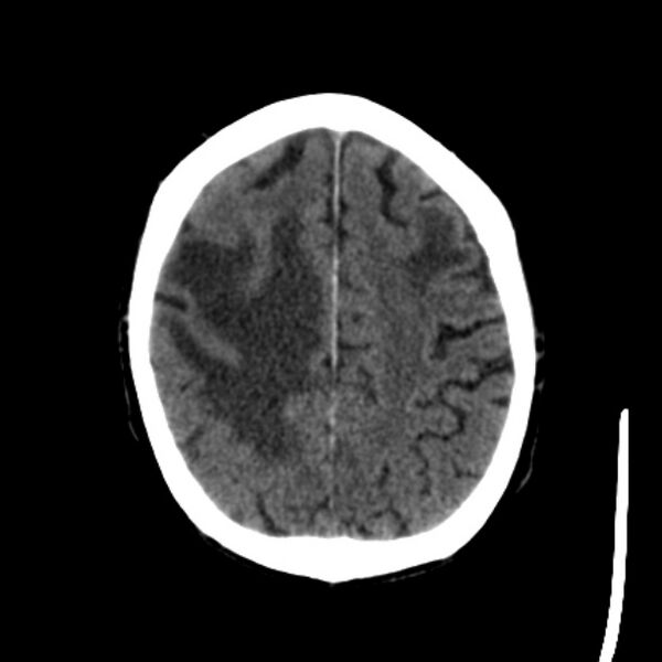 File:Brain metastases from lung cancer (Radiopaedia 27849-28092 Axial non-contrast 35).jpg