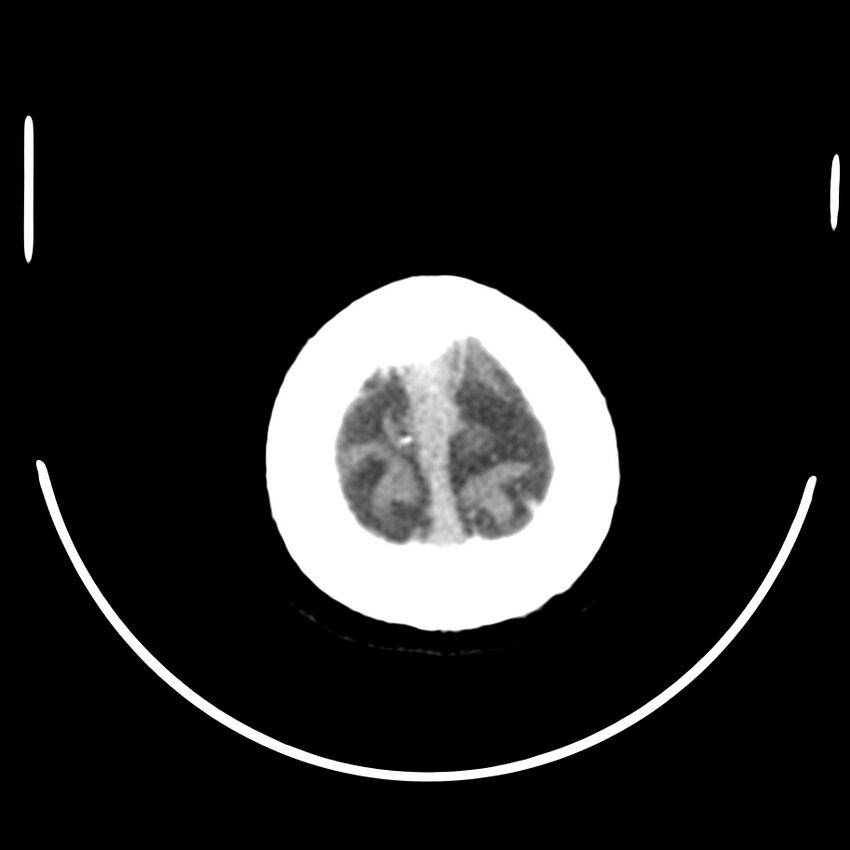 Brain metastasis (Radiopaedia 42617-45760 Axial non-contrast 50).jpg
