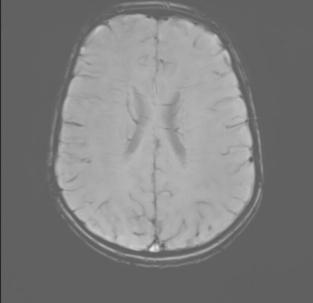 File:Brainstem glioma (Radiopaedia 70548-80674 Axial SWI 41).jpg