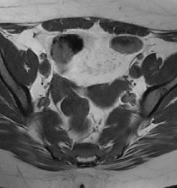 File:Broad ligament leiomyoma (Radiopaedia 81634-95516 Axial T1 9).jpg