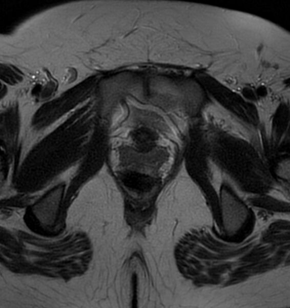 File:Broad ligament leiomyoma (Radiopaedia 81634-95516 Axial T2 24).jpg
