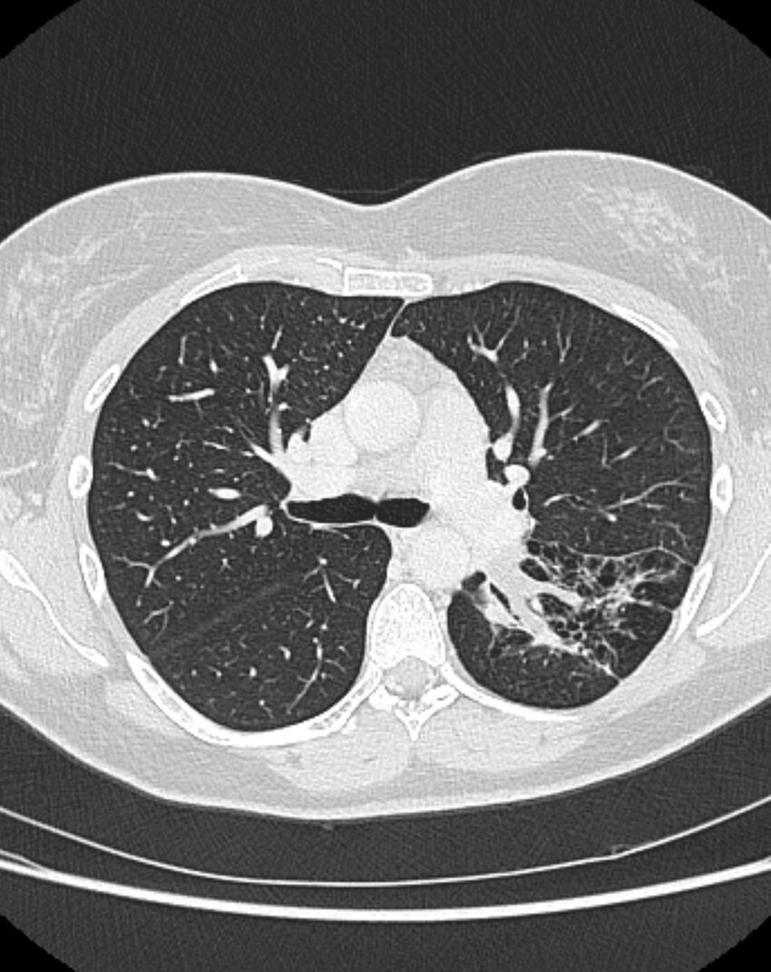 Bronchial atresia (Radiopaedia 50007-55297 Axial lung window 41).jpg