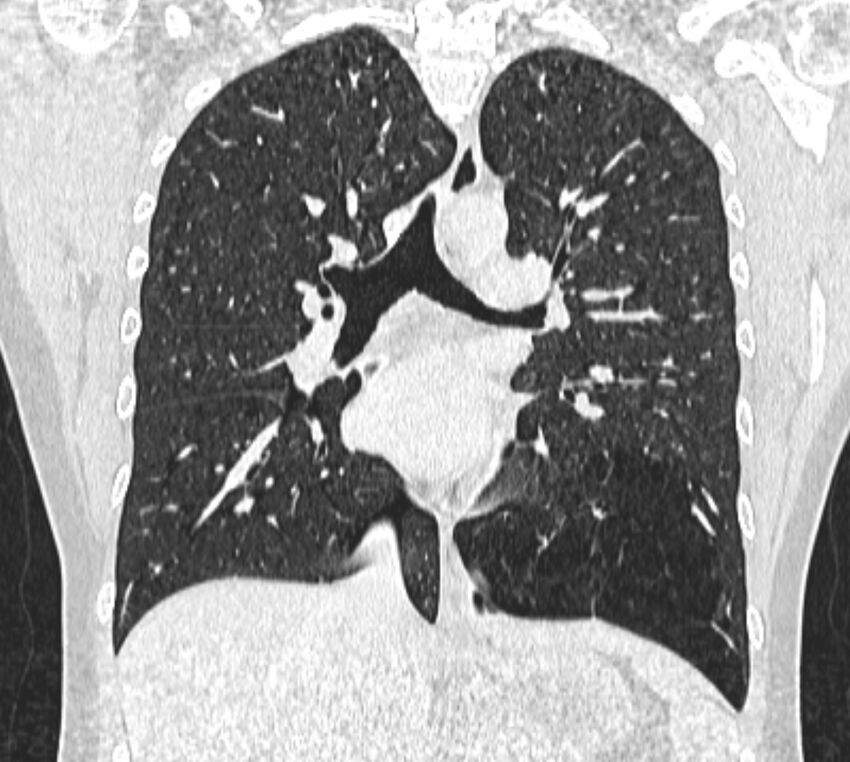 Bronchial atresia (Radiopaedia 50007-55297 Coronal lung window 58).jpg