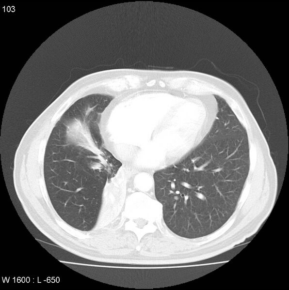 File:Bronchial carcinoid tumor with right lower lobe collapse (Radiopaedia 29060-29422 B 41).jpg