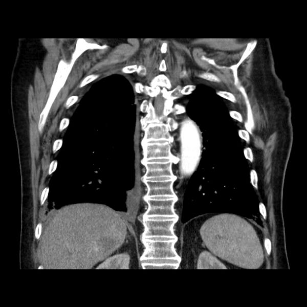 File:Bronchogenic adenocarcinoma and pulmonary embolism (Radiopaedia 9097-9806 C 38).jpg