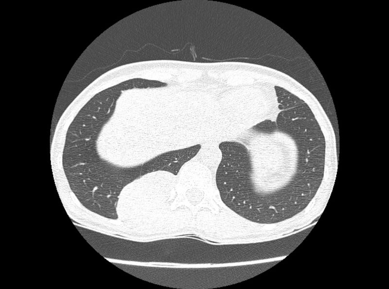 File:Bronchogenic cyst (Radiopaedia 80273-93615 Axial lung window 26).jpg