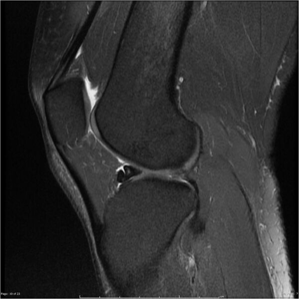 File:Bucket handle tear - lateral meniscus (Radiopaedia 7246-8187 Sagittal T2 fat sat 10).jpg