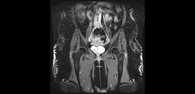 File:Buttock filler complications (Radiopaedia 63497-72115 Coronal T1 C+ 13).jpg