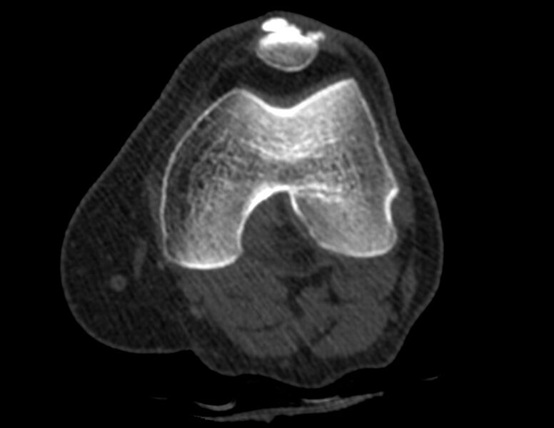 File:Calcified hematoma - popliteal fossa (Radiopaedia 63938-72763 Axial bone window 2).jpg