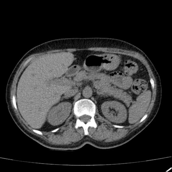 File:Calcified hepatic hydatid cyst (Radiopaedia 26872-27046 Axial non-contrast 28).jpg