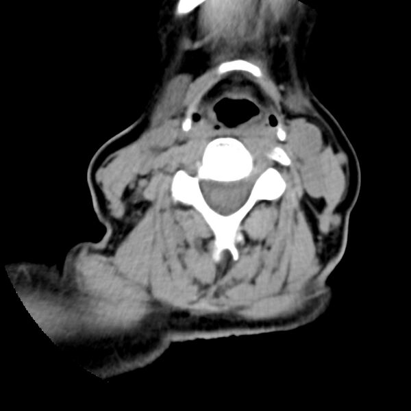 File:Calcified meningioma - cervical canal (Radiopaedia 70136-80171 B 19).jpg