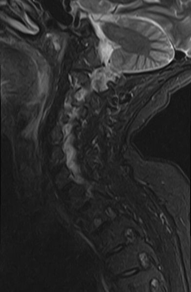 File:Calcified meningioma - cervical canal (Radiopaedia 70136-82468 Sagittal STIR 10).jpg