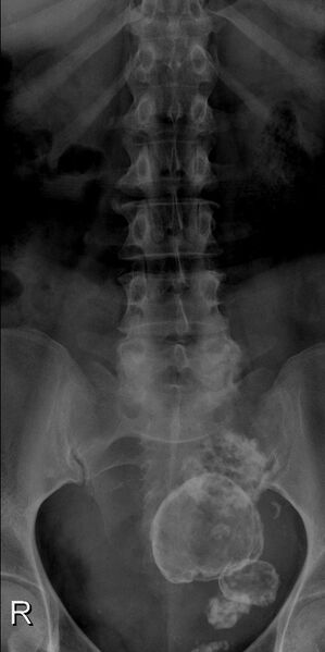 File:Calcified uterine fibroids (Radiopaedia 85169).jpg