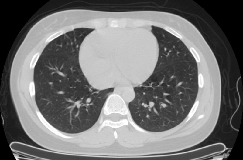 File:Cannonball metastases - uterine choriocarcinoma (Radiopaedia 70137-80173 Axial lung window 75).jpg