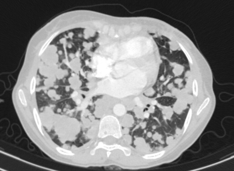 File:Cannonball metastases from breast cancer (Radiopaedia 91024-108569 Axial lung window 58).jpg