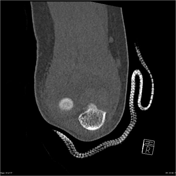 File:Capitellum fracture (Radiopaedia 23352-23426 Coronal bone window 34).jpg