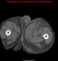 Cardiac perforation following transcatheter aortic valve implantation (Radiopaedia 23714-23863 B 33).png