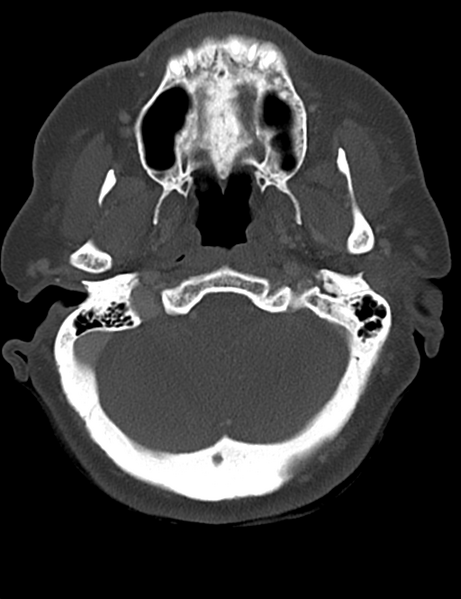 File:Causes of dysphagia (Radiopaedia 40149-42657 Axial bone window 10).png