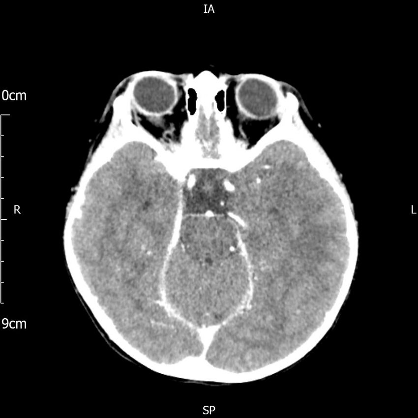 Cavernous sinus thrombosis (Radiopaedia 79414-92510 Axial Brain 85).jpg