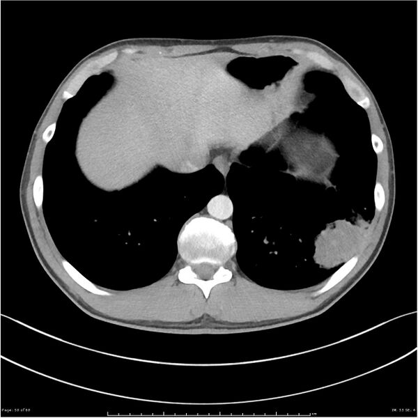 File:Cavitating lung cancer (Radiopaedia 25796-25945 C+ arterial phase 50).jpg