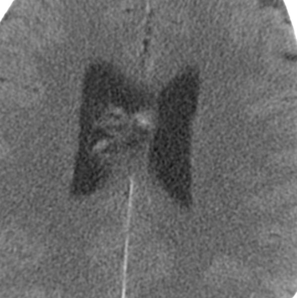 File:Central neurocytoma (Radiopaedia 68725-78432 C 4).jpg