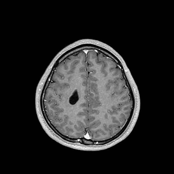 File:Central neurocytoma (Radiopaedia 79320-92380 Axial T1 C+ 180).jpg