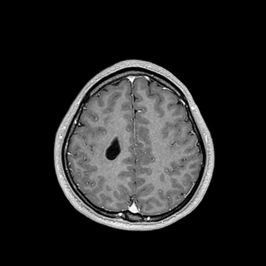 Central neurocytoma (Radiopaedia 79320-92380 Axial T1 C+ 180).jpg