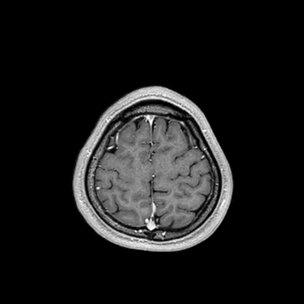 File:Central neurocytoma (Radiopaedia 79320-92380 Axial T1 C+ 201).jpg