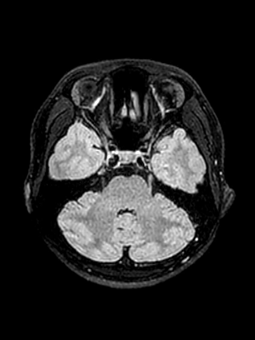 Central neurocytoma (Radiopaedia 79320-92381 Axial FLAIR 119).jpg