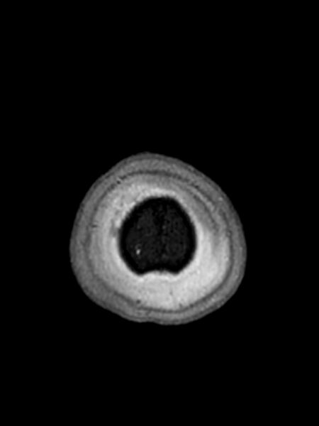 File:Central neurocytoma (Radiopaedia 79320-92381 Axial FLAIR 19).jpg