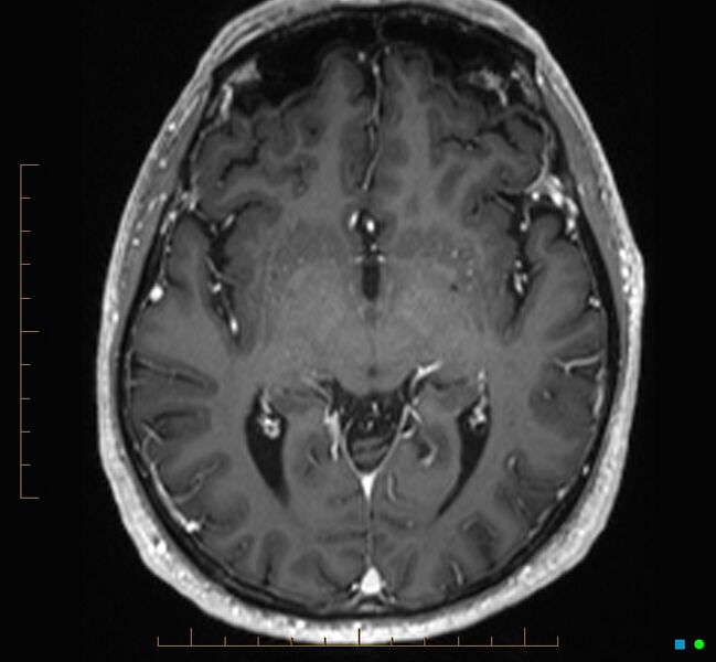 File:Cerebellar gangliocytoma (Radiopaedia 65377-74422 Axial T1 C+ 59).jpg