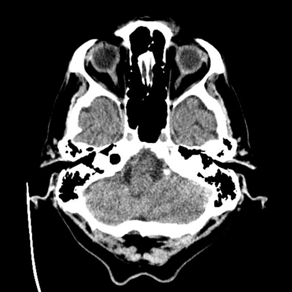 File:Cerebellar hemorrhage (Radiopaedia 27193-27359 Axial non-contrast 7).jpg