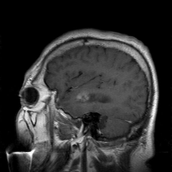 File:Cerebellopontine angle meningioma (Radiopaedia 24459-24764 Sagittal T1 C+ 5).jpg
