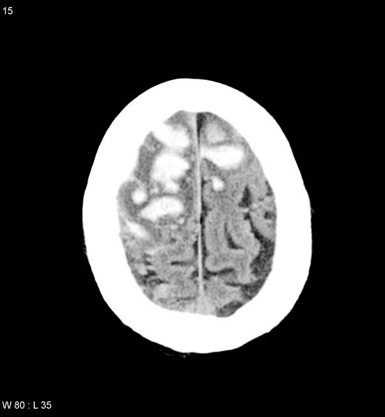 File:Cerebral abscesses secondary to contusions (Radiopaedia 5201-22213 Axial non-contrast 8).jpg