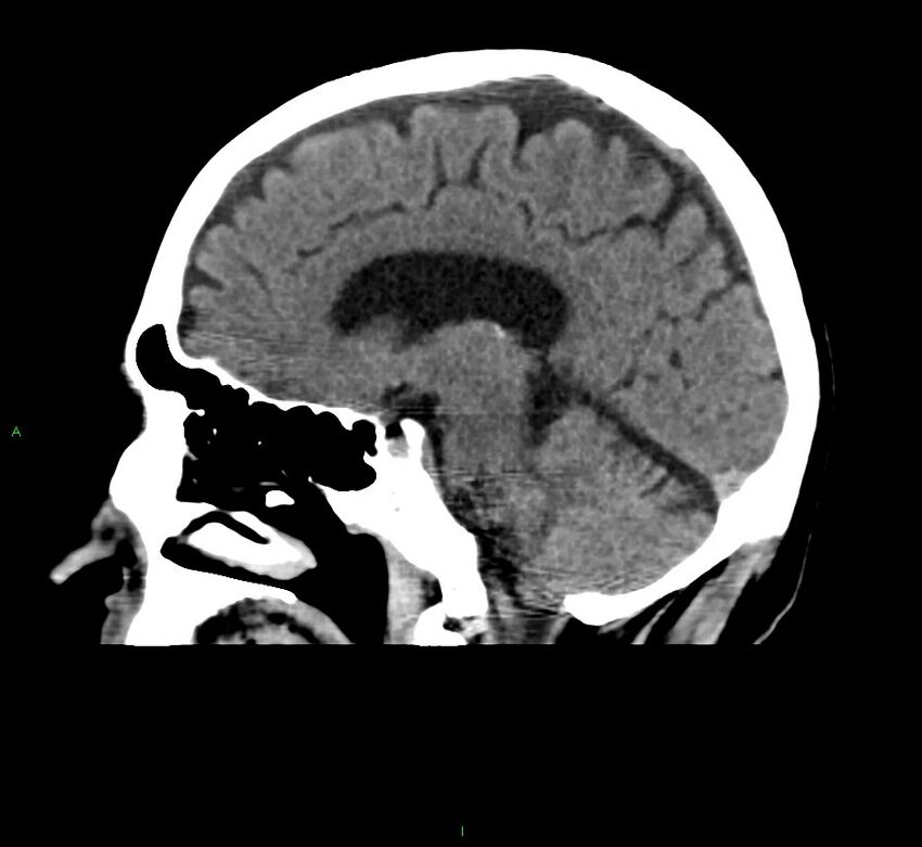 Cerebral amyloid angiopathy-associated lobar intracerebral hemorrhage (Radiopaedia 58376-65511 C 24).jpg