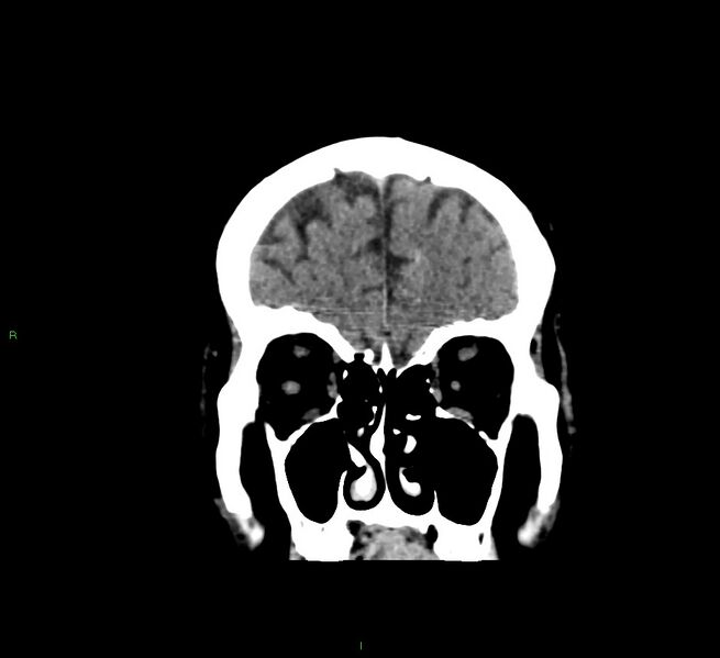 File:Cerebral amyloid angiopathy-associated lobar intracerebral hemorrhage (Radiopaedia 58376-65511 Coronal non-contrast 53).jpg