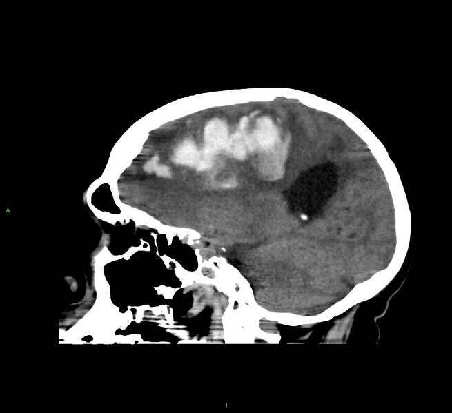 File:Cerebral amyloid angiopathy-associated lobar intracerebral hemorrhage (Radiopaedia 58560-65723 C 21).jpg